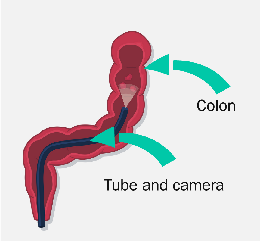 A piece of intestines with an arrow pointing to the colon and another arrow pointing to the tube and camera inside the colon.