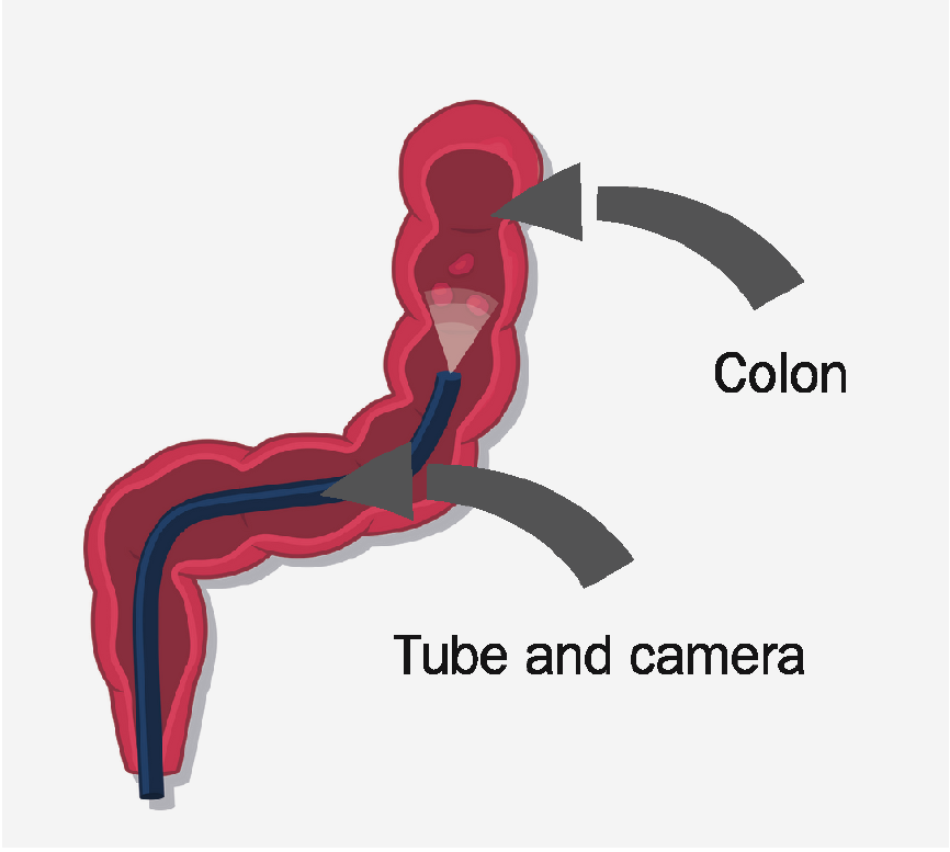 A graphic of intestines. There is an arrow pointing to the colon and another arrow pointing to a tube and camera.