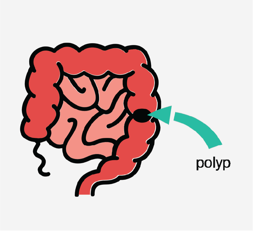 A graphic of a colon with an arrow pointing to a polyp.