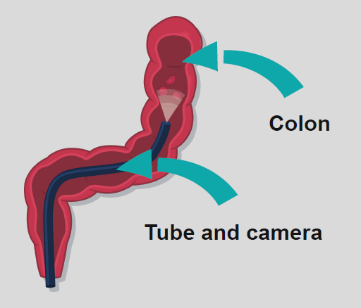 A diagram of a colon with a tube and camera inside.