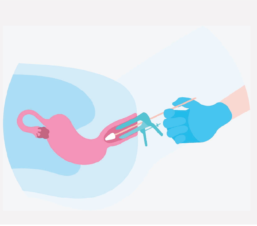 A hand inserting a speculum into a female's pelvis.