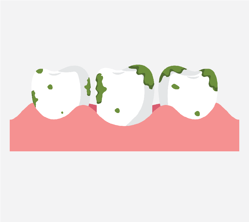 Graphic of teeth with germs on them, they are dirty.
