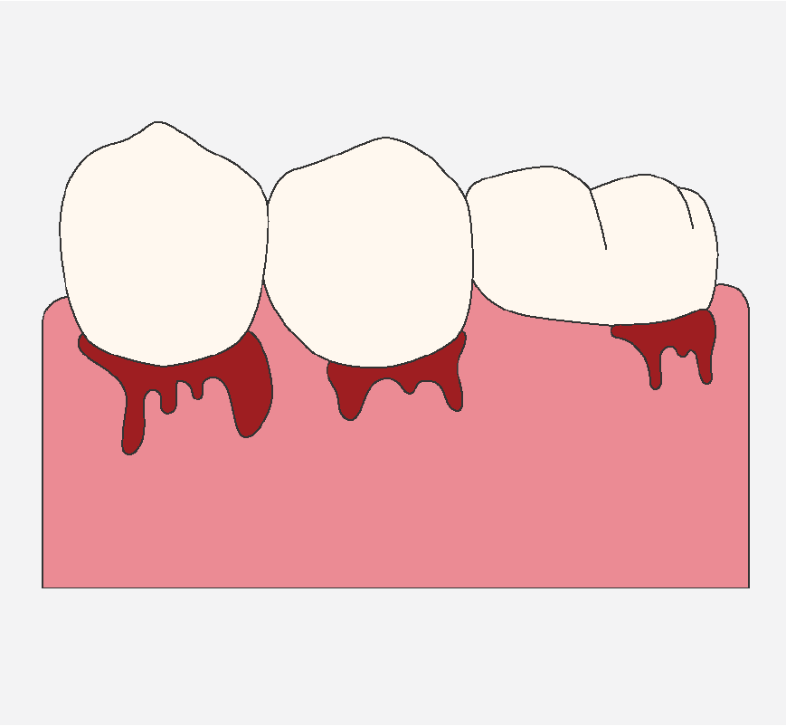 Graphic of teeth that have inflamed gums, they are bleeding.