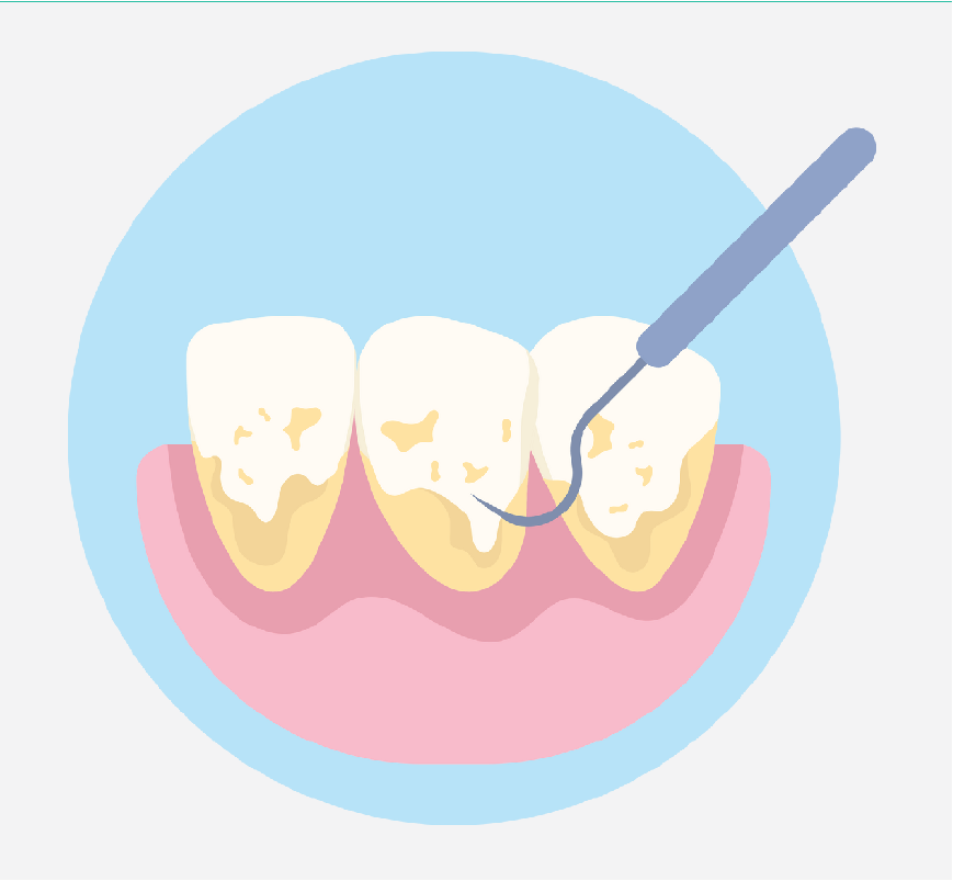 Graphic of dirty teeth getting cleaned by a dental tool.
