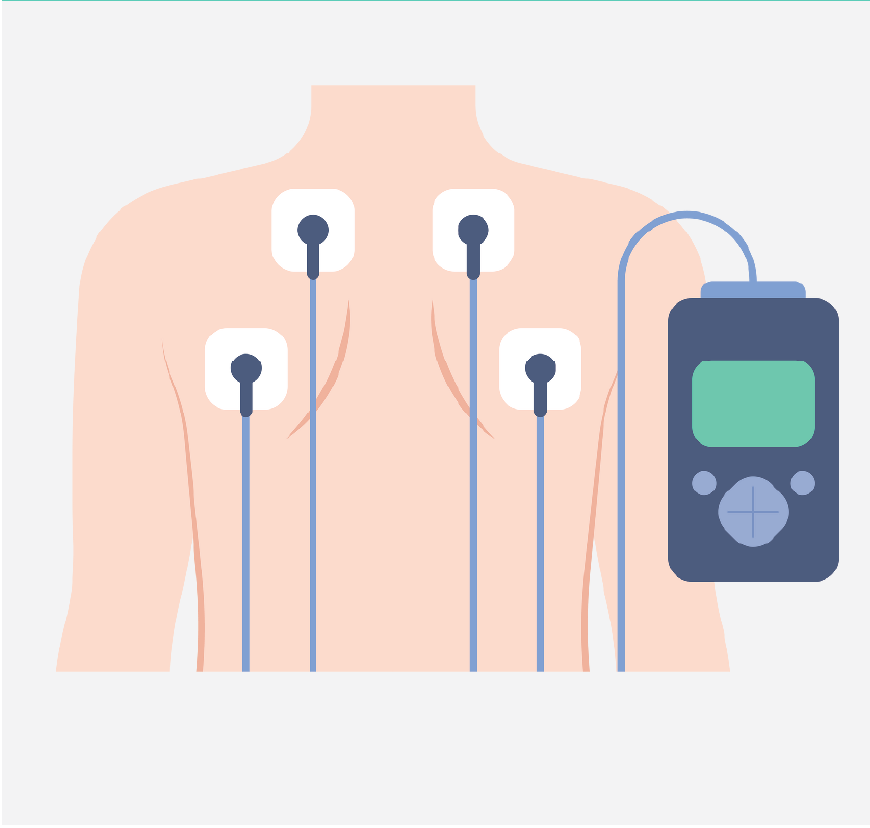 Graphic of a man's chest with EKG electrodes on his chest.