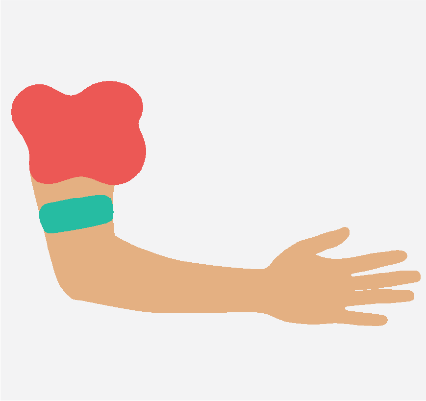Graphic of an arm with a large green rubber band on it.